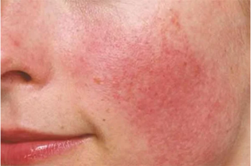 Da mặt bị kích ứng do sử dụng tẩy da chết vật lý sai cách